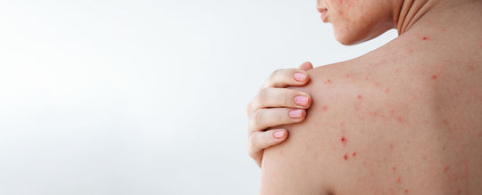 Akne nach dem Sommer: Rebound-Effekt und wie man ihn verhindert